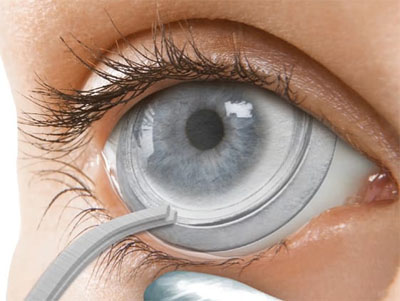 Amniotic Membranes - Dry eye treatment