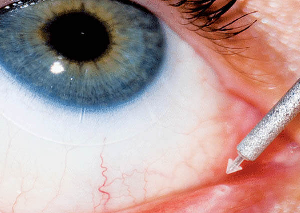 Dry eyes - Diagnosis & treatment